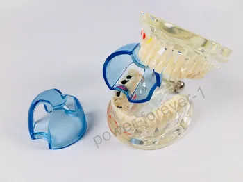 5Pis-100Pis Dental Boca Dentes Posteriores Mordaça Adereços Abridor Bochecha Afastador Backteeth Molar Composto Azul/Limpar